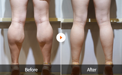 Before&After