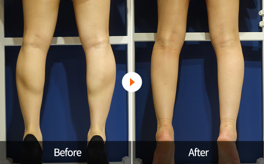 Before&After