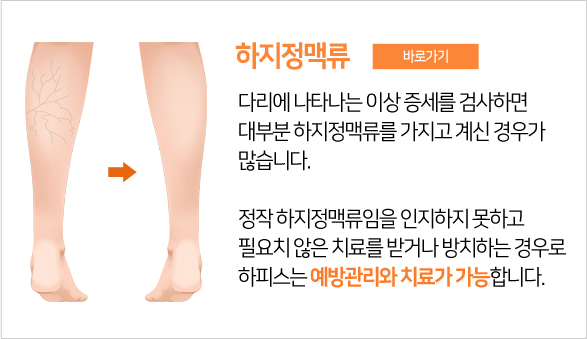 하지정맥류