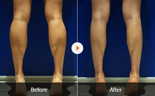 Before&After