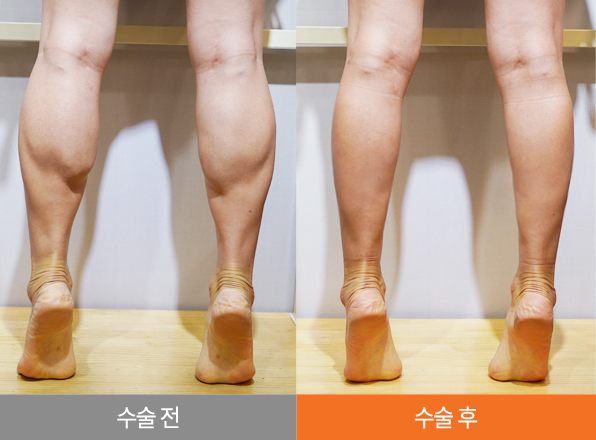 하피스 종아리 성형