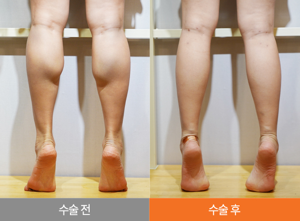 하피스 종아리 성형